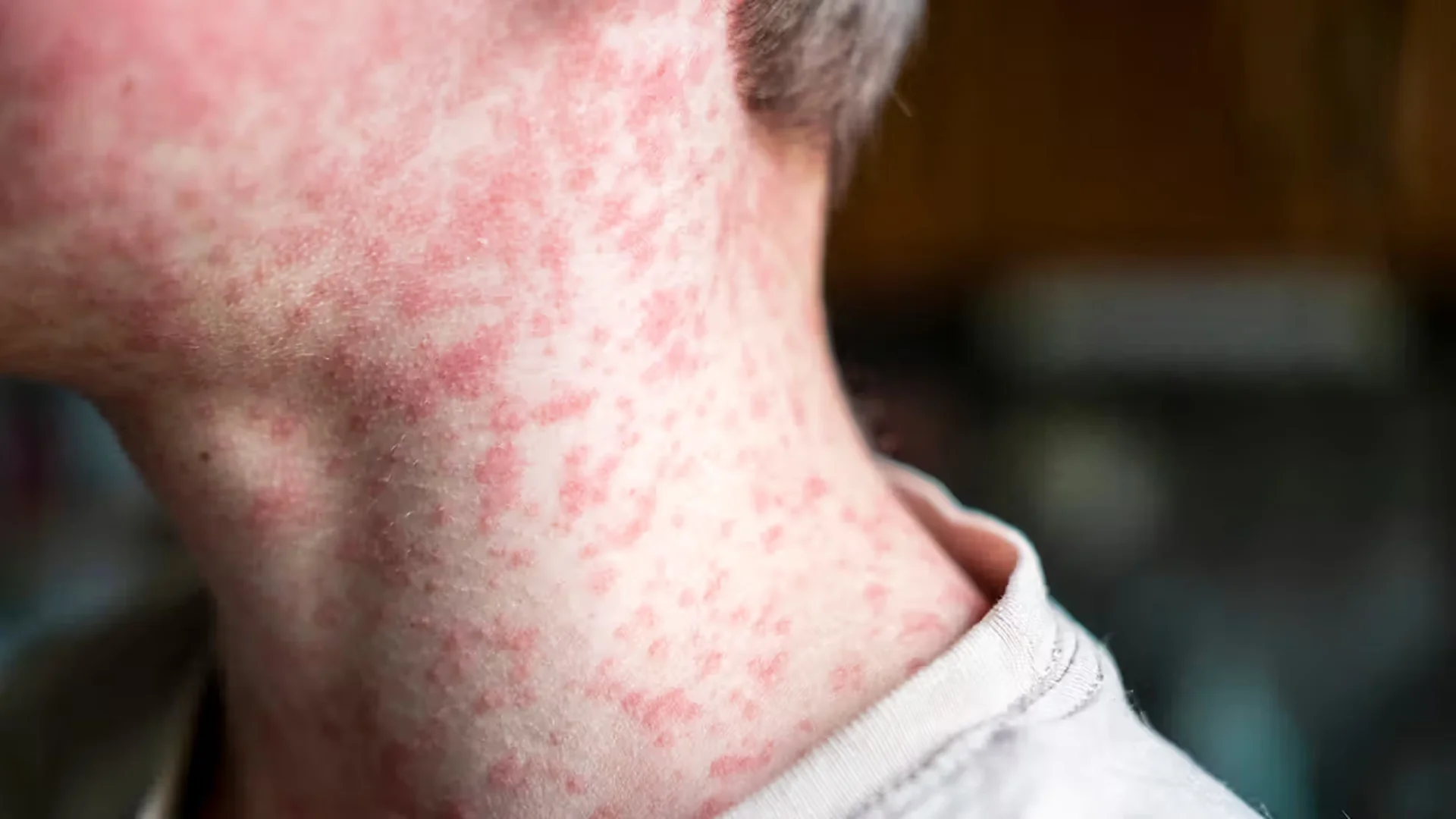 Measles rash on the face and neck of a teenage boy. Photo: Natalya Maisheva/Getty Images