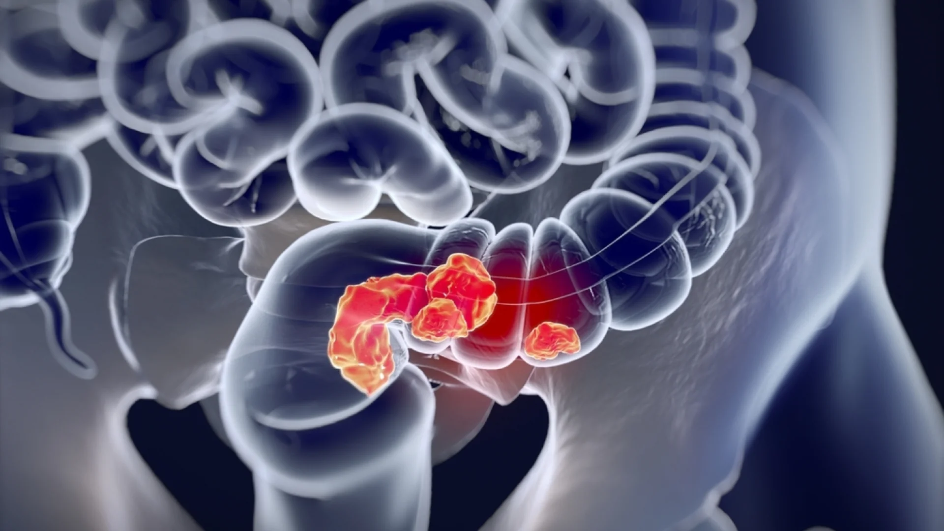 3D medical anatomical illustration showing colorectal cancer in the large intestine. Credit: Weill Cornell Medicine.