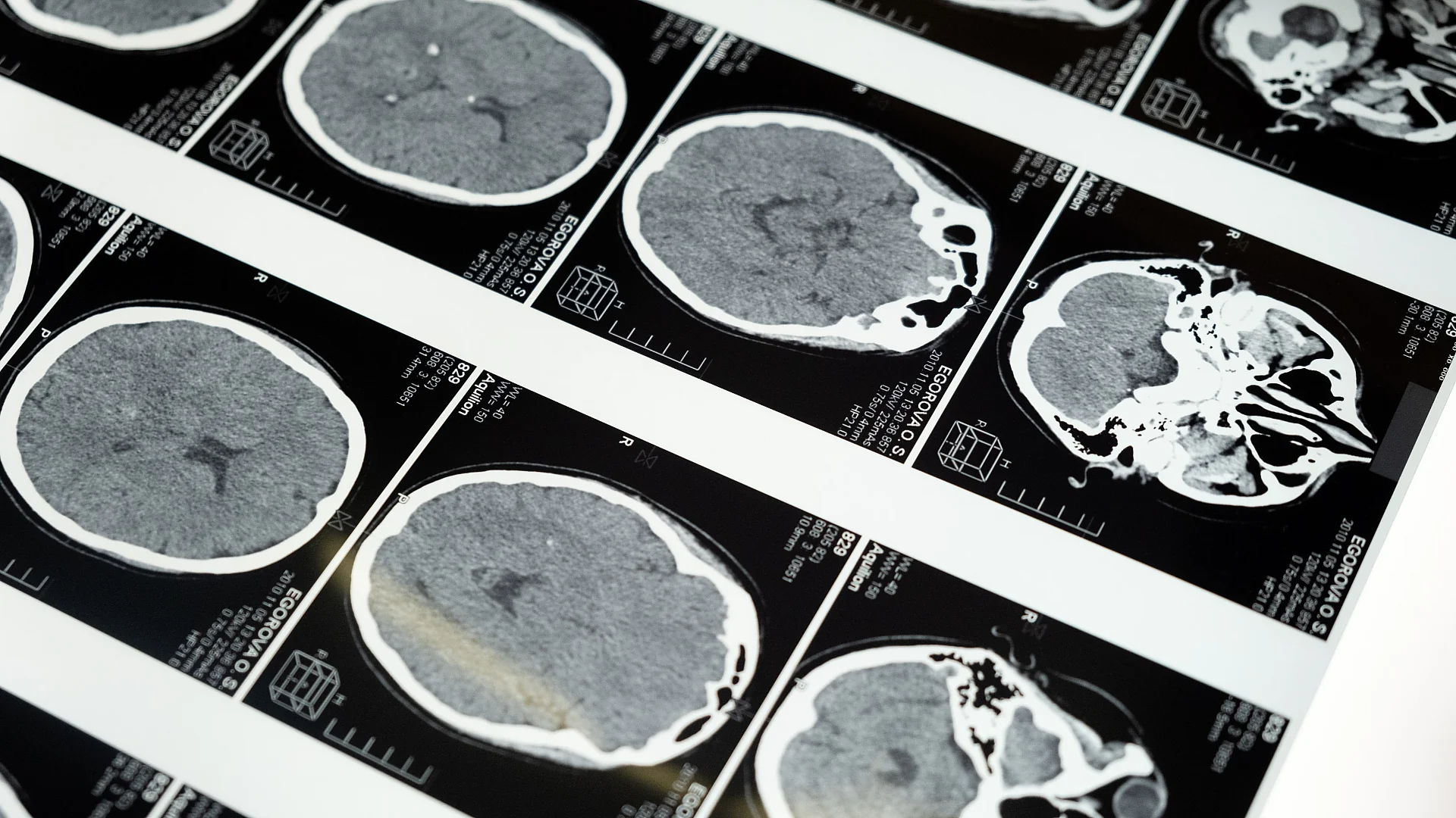 Detailed brain MRI scan film sheets displayed on an illuminated lightbox demonstrating medical diagnostic imaging techni